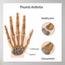 Base del poster de la artritis del pulgar