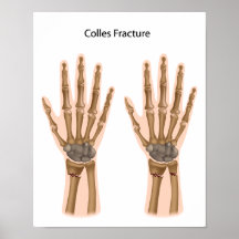 Colles fractura el poster