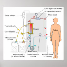 Diagrama de un tratamiento médico de la hemodialis posters