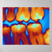 Dientes con los rellenos (verde), radiografía colo poster