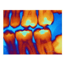 Dientes con los rellenos (verde), radiografía colo postal