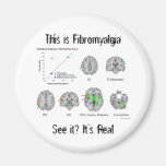 El Fibromyalgia es real. prueba del fMRI Imanes