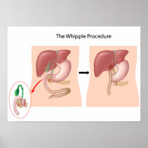 El poster del procedimiento de Whipple