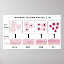 Etapas de la displasia y prueba cervicales del pru posters