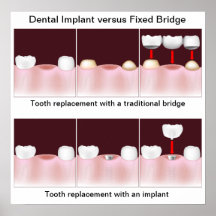Implante dental contra el poster del puente