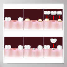 ¡Los implantes dentales contra el puente fijo, aña Poster