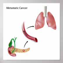 Metástasis del cáncer a través del poster de la ci