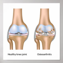 Osteoartritis del poster de la junta de rodilla