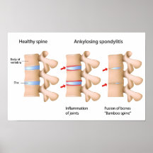 Poster Ankylosing del spondylitis de la espina dor
