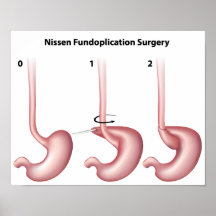 Poster de la cirugía del estómago de Nissen Fundop