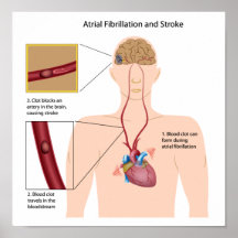 Poster de la fibrilación atrial y del movimiento