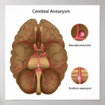 Poster del aneurysm cerebral
