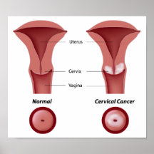 Poster del cáncer de cuello del útero