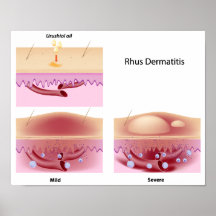 Poster del dermatitis de contacto del Rhus