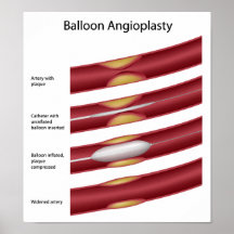 Poster del procedimiento de la angioplastia del gl
