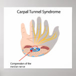 Poster del síndrome del túnel carpiano