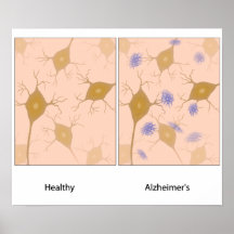 Poster del tejido cerebral de la enfermedad de Alz
