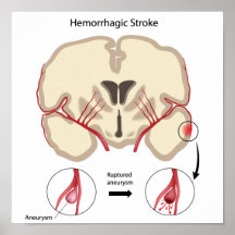 Poster hemorrágico del movimiento del cerebro