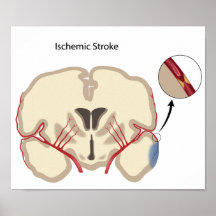 Poster isquémico del movimiento del cerebro