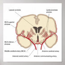 Poster medio de la arteria cerebral