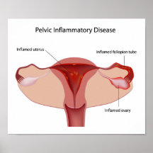 Poster pélvico de la enfermedad inflamatoria