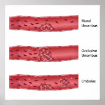 Tipos de poster de la trombosis