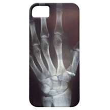 X caja del teléfono de la mano del rayo iPhone 5 Case-Mate protectores