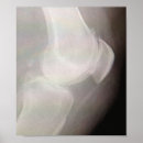 Buscar artritis posters Ortopédico