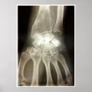 Buscar huesos de mano posters Médica