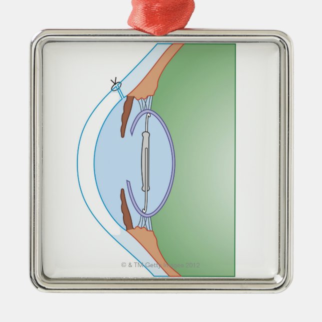 Adorno Metálico Cirugía de la catarata (Frente)