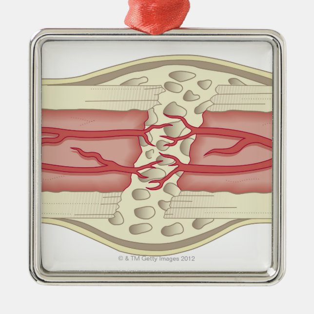 Adorno Metálico Hueso que se repara 2 (Frente)