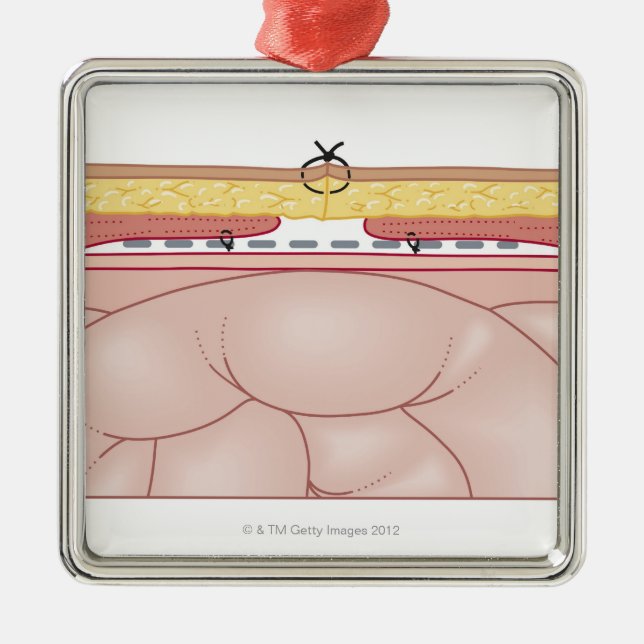 Adorno Metálico Ilustracion de una hernia (Frente)