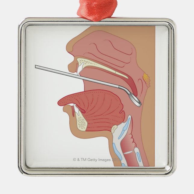 Adorno Metálico Laringoscopia del espejo (Frente)