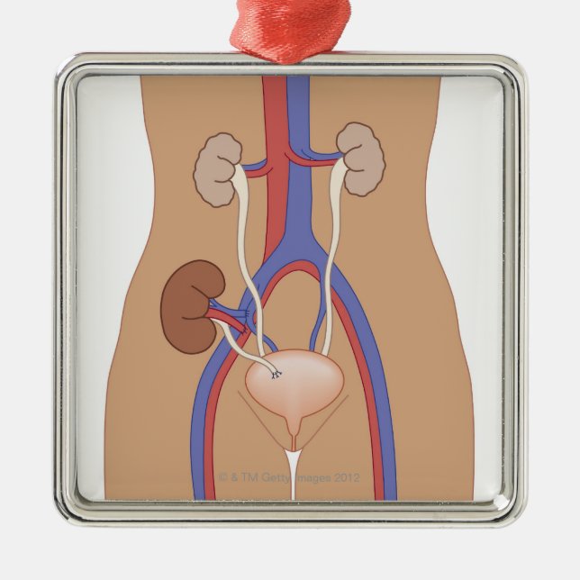 Adorno Metálico Trasplante de riñón (Frente)