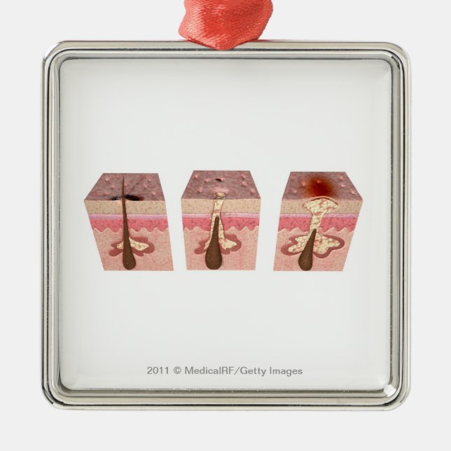 Adorno Metálico Vista de qué causa acné (Frente)