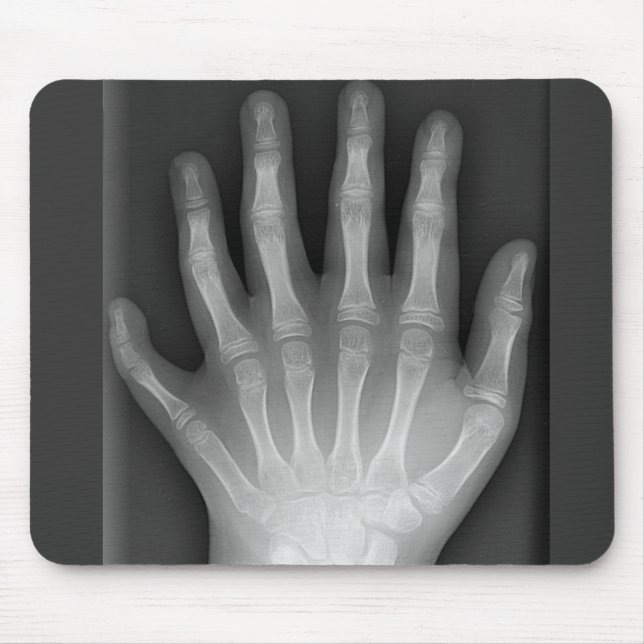 Alfombrilla De Ratón Mano de seis dedos, Raridad médica, rayos X (Frente)