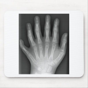 Alfombrilla De Ratón ¡Polydactyly, seis manos digitadas, radiografía,