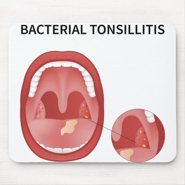 Alfombrilla De Ratón Tonsilitis bacteriana (Frente)