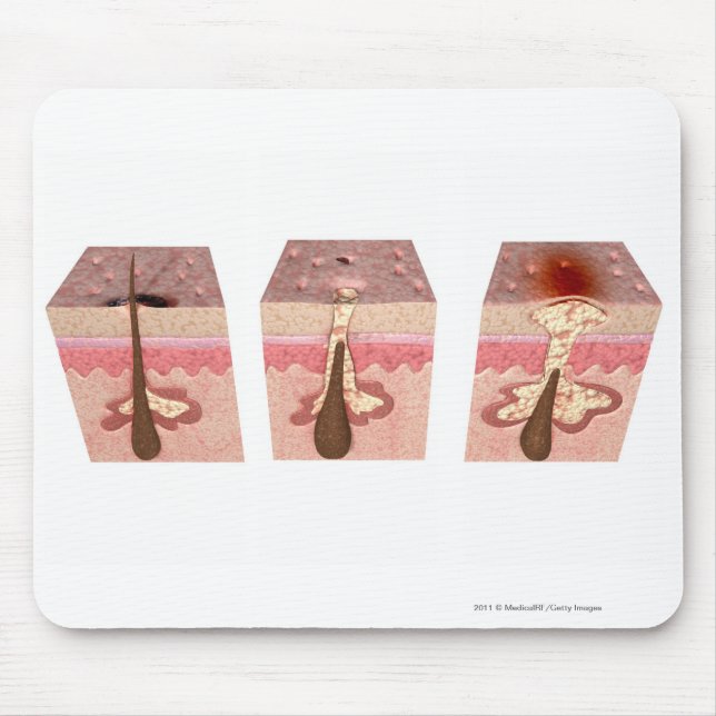 Alfombrilla De Ratón Vista de qué causa acné (Frente)