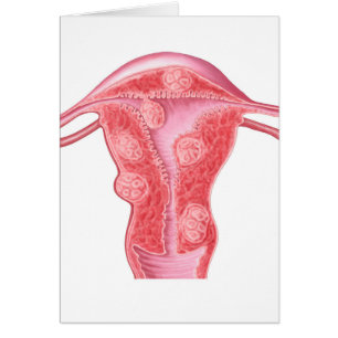 Anatomía de tumores fibroides en útero femenino