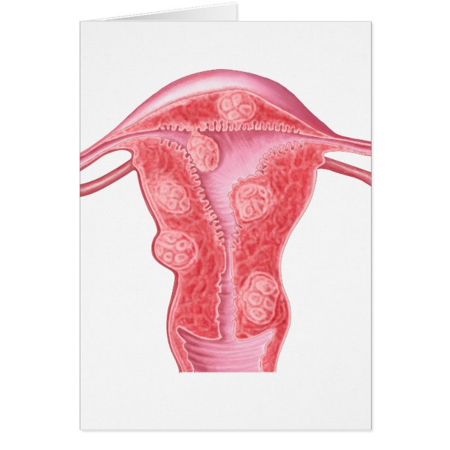 Anatomía De Tumores Fibroides En Uterus Femenino (Frente)