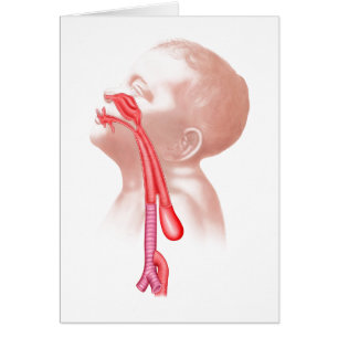 Anatomía de una fístula traqueoesofágica