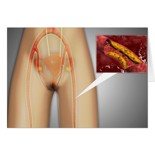 Arteria estrecha cerca del cierre de la pierna (Anverso (Horizontal))