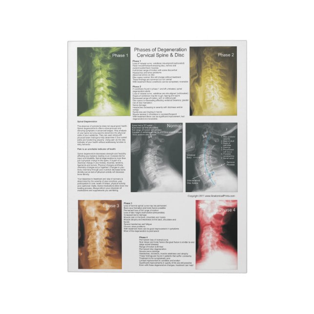 Bloc De Notas Degeneración de la espina dorsal cervical (Lado Izquierdo)
