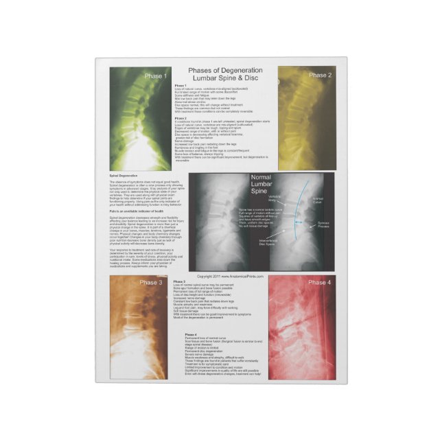 Bloc De Notas Degeneración de la espina dorsal lumbar (Lado Izquierdo)