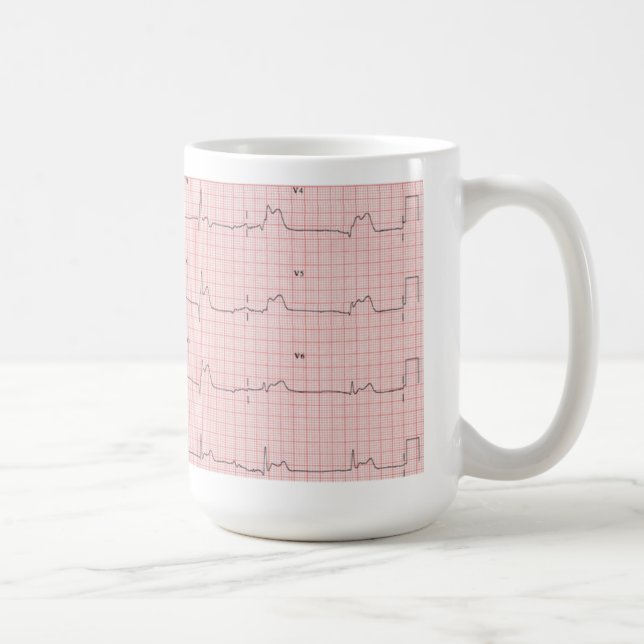 Café Taza de ECG (Derecha)