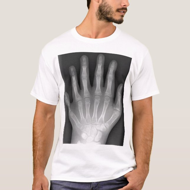 Camiseta ¡Polydactyly, seis manos digitadas, radiografía, (Anverso)
