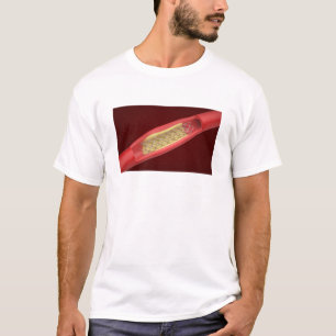 Camiseta Stent médico dentro del vaso sanguíneo