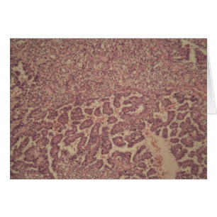 Células de la glándula tiroides con el cáncer