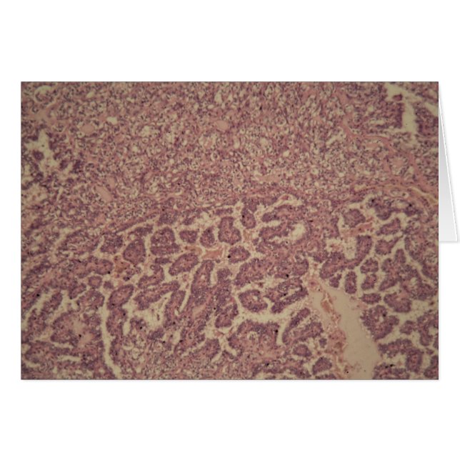 Células de la glándula tiroides con el cáncer (Anverso (Horizontal))